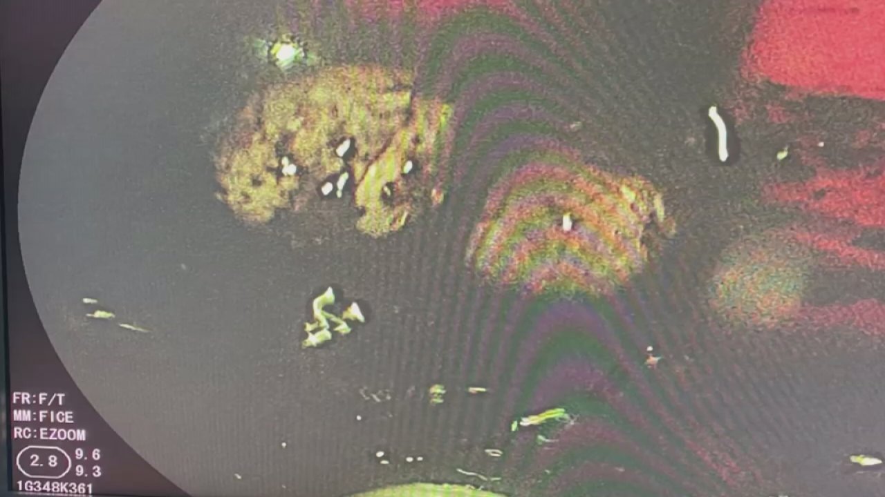 Midesine Sakladığı Uyuşturucu Dolu Kapsüller Patlayan İsveçli Öldü