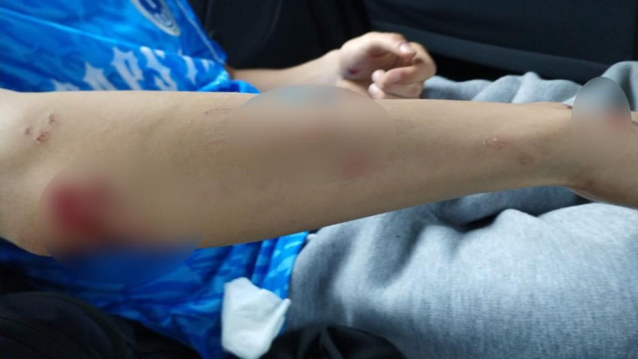 Köpeklerin Saldırdığı Lise Öğrencisi Yaralandı