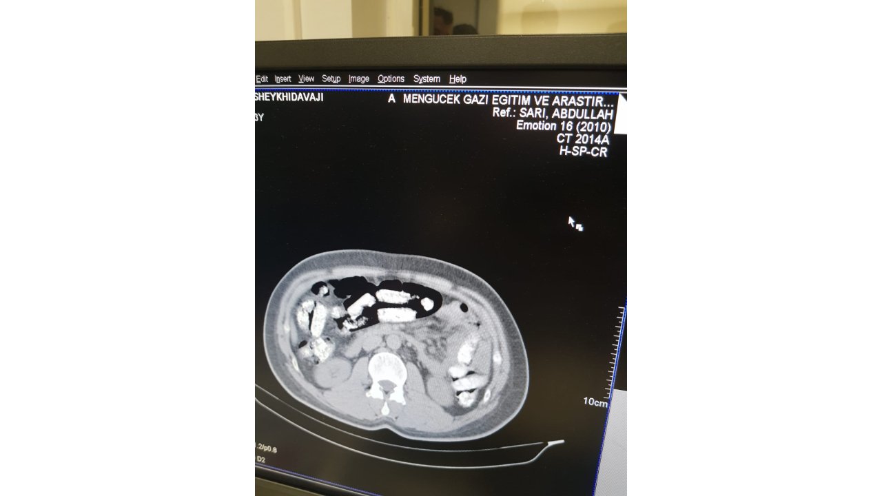 Midesinden 1 Kilo 198 Gram Uyuşturucu Çıktı