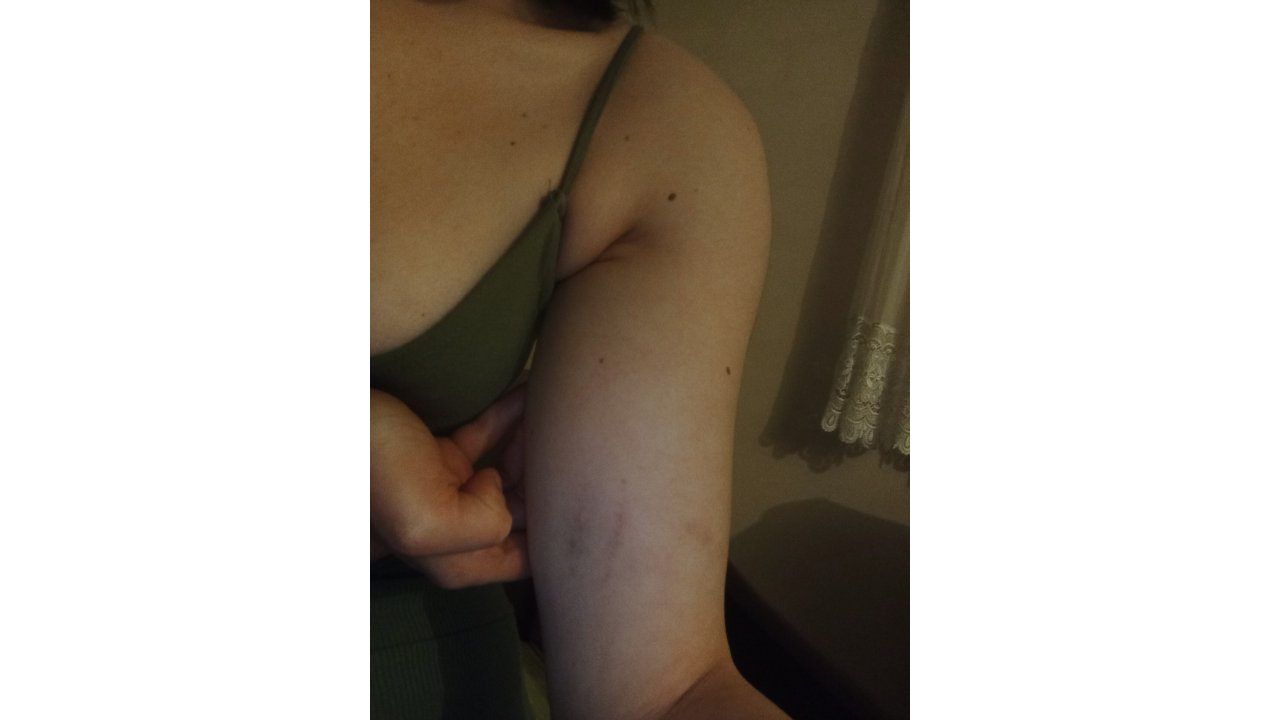 İlişki İsteğine Ret Cevabı Veren Sevgilisini Darbetti - Yeniden