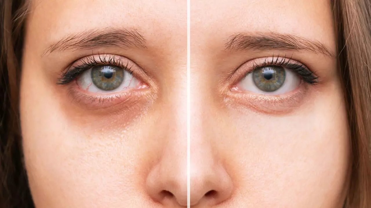 Gözaltı kararmalarını gideren patates maskesi tarifi