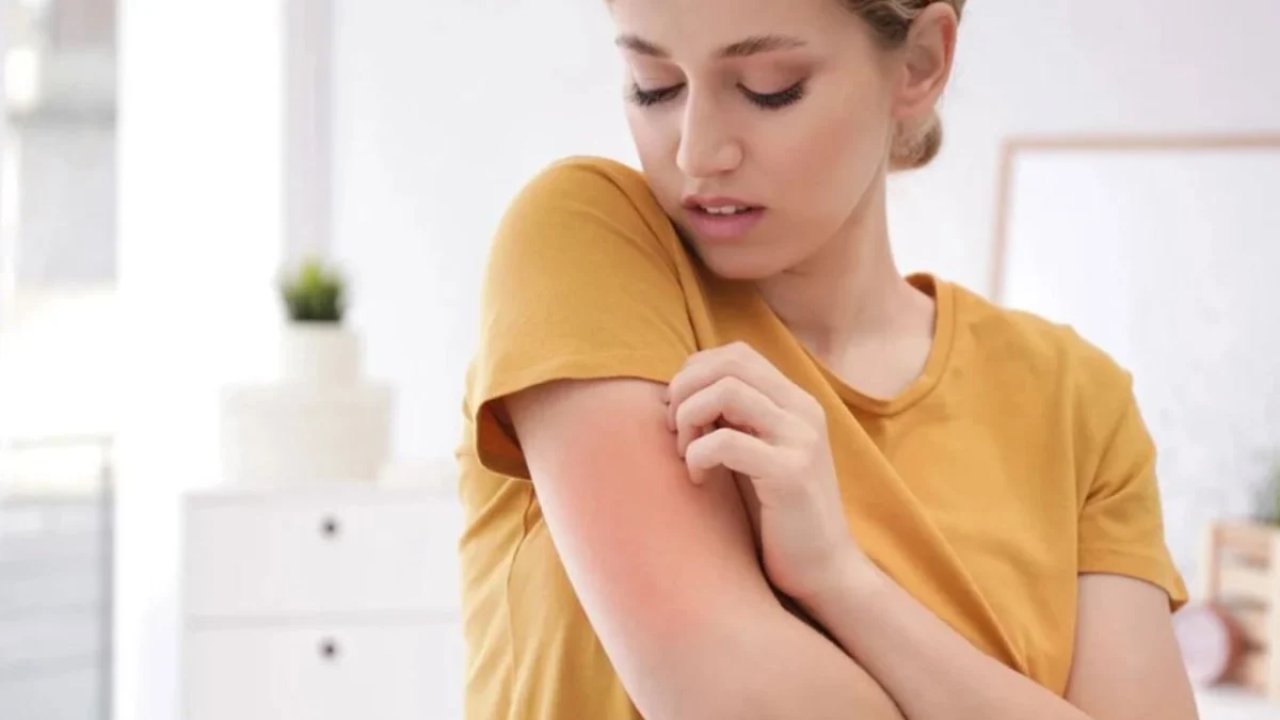 Uyuz vakalarında dev artış