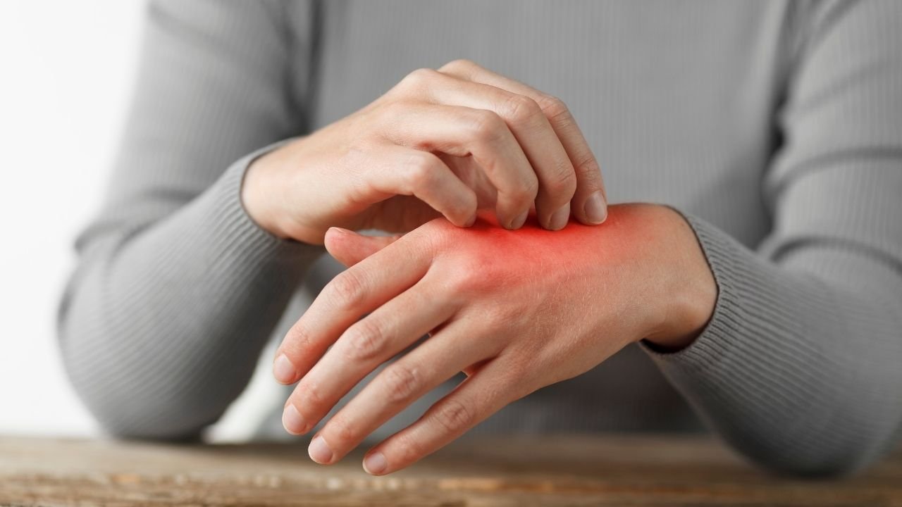 Egzamayı azdıran 8 yiyecek! Bunlardan kesinlikle uzak durun