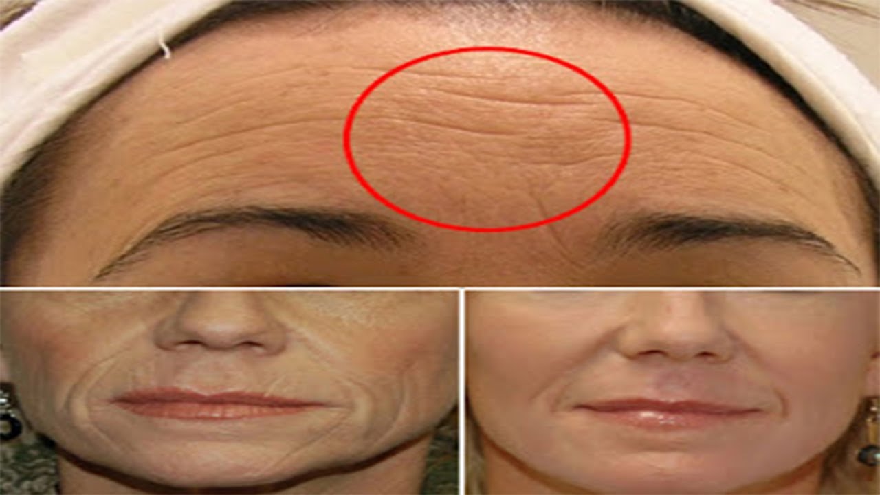 Botoks Yaptırmadan Kırışıkları Gideren Yöntem